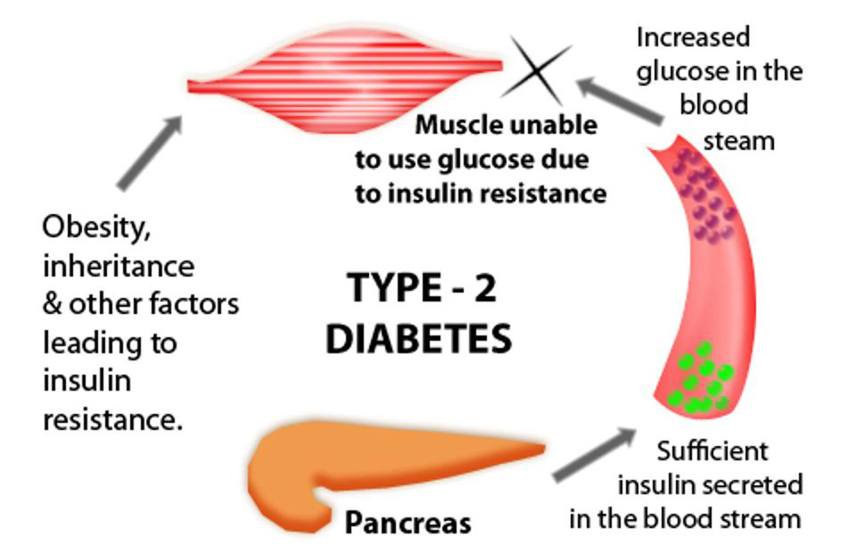 presentation of diabetes type 2
